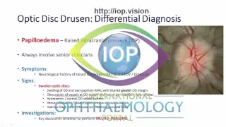 Optic Disc Drusen Part 2 Preview