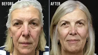 How does a Non-Surgical Facelift work? Susan's Vivalift Explained!