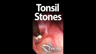 Tonsil stones forming in a large tonsil fissure.