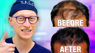 Best Hair Transplant Recovery