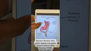 Bariatric Revision after gastric bypass