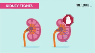 Kidney Stones (Renal Calculi) Nursing NCLEX RN & LPN