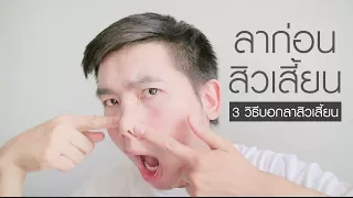 3 วิธีรักษาสิวเสี้ยนด้วยตัวเอง