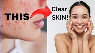 Insulin Resistance and Acne! Cure Acne with These Easy Steps. Keep Clear Skin and Control Diabetes