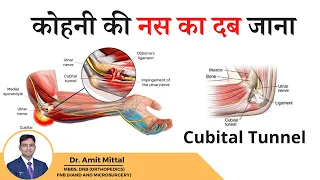 कोहनी की नस का दब जाना Ulnar nerve | Cubital Tunnel syndrome in Hindi