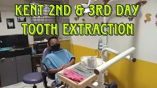 Part 2: Kent 2nd & 3rd Tooth Extraction ll Jankent Vlog