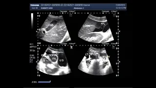 Ultrasound Video showing a scan of ruptured appendix.