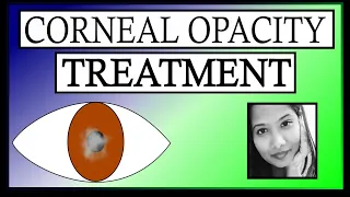 Treatment of Corneal Opacity | Keratoplasty, PTK, OI, Tattooing, Contact lenses