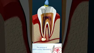 Root Canal Treatment & Tooth Abscess