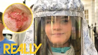 11-Year-Old Has Rare Condition That Makes Her Develop Multiple Skin Cancers | The Bad Skin Clinic