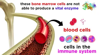 Gene Therapy