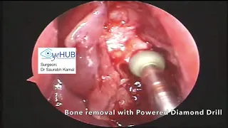 Endoscopic Revision Dacryocystorhinostomy (DCR) - for watering in eyes, tear duct blockage