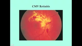 Retinitis - CRASH! Medical Review Series