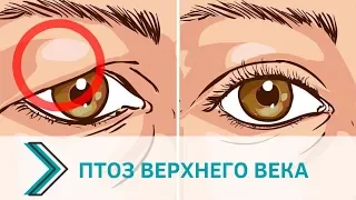 Птоз верхнего века: коррекция без скальпеля