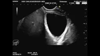 Pólipo de vesícula biliar diagnosticado por medio de Ultrasonido Endoscópico