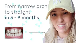 How clear aligners can expand a narrow dental arch at home