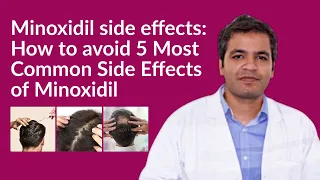 Minoxidil side effects: How to avoid Minoxidil side effects | 5 Common Side Effects of Minoxidil