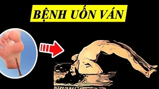 Tìm hiểu Bệnh Uốn ván cực kỳ Nguy hiểm trong 5 phút