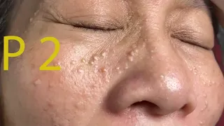 Make your Acne Treatment Huong Da Nang#502 | acne 2022 PArt 2