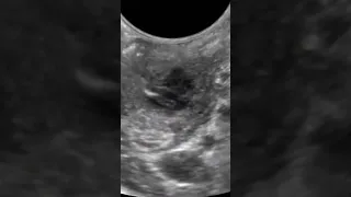 Draining Peritonsillar Abscess with #POCUS