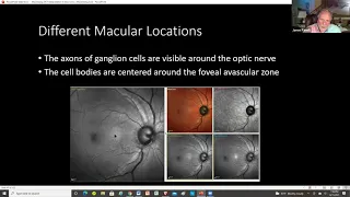 Maximizing OCT Interpretation in Glaucoma Equals Maximizing Care