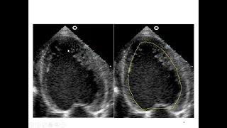 answer to Q10 : pitfalls in tracing Endocardium