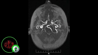 МРТ сосудов головного мозга (что видно на снимках)