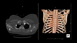 Anatomy - Chest CT