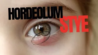 Stye (Hordeolum)