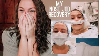 i got a nose job?! my recovery from septoplasty & turbinoplasty (ROUGH)