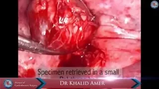 Video assisted thoracoscopic excision of mediastinal ectopic parathyroid adenomas