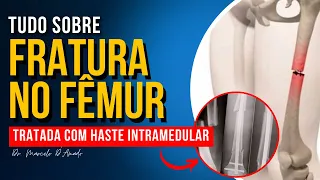 O QUE É E O TIPO DE HASTE INTRAMEDULAR USADA NA FRATURA DIAFISÁRIA DO FÊMUR!