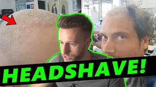 Connor Murphy Shaves His Head 4 Months after Hair Transplant! How does it look so far?