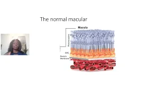 An introduction to the macula and the diseases that affect it with Dr Christiana Dinah