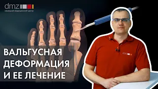 Вальгусная деформация стопы и ее лечение