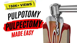 Pulpotomy and Pulpectomy | PEDIATRIC DENTISTRY