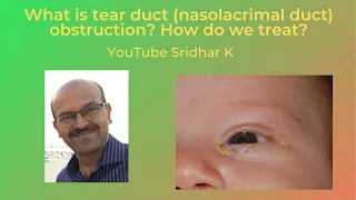 Sticky eyes in babies. Nasolacrimal duct obstruction in babies. Watering eyes in babies.