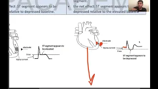 ECG highlights  part 2 - abnormalities