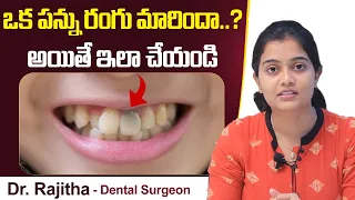 ఒక పన్ను రంగు | How to Whiten a Single Dark Tooth | Tooth Discoloration | Eledent Dental Hospitals