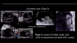 Breast Ultrasound  Complicated Vs Complex Cyst