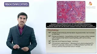 Vascular tumors - Angiosarcoma - Definition, Epidemiology, Pathology, Diagnosis and treatment