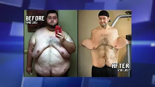 Losing over 300 Pounds Has Left Man with Significant Excess Skin