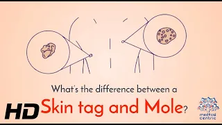 Decoding Skin Bumps: Mole vs. Skin Tag - Know the Difference!