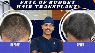 Hair Transplant In India | Cost Of Hair Transplant In India
