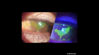 Fluorescein Stain Test