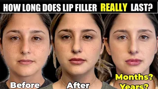 How Long does Lip Filler Last? How Often Should You get Your Lips Redone?