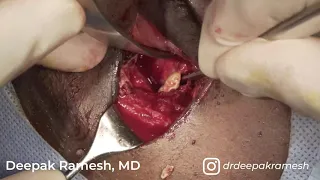 Orbital Tumor Removal (with lateral marginotomy)