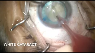 White Cataract Surgery- 17Sep2020 (#170)