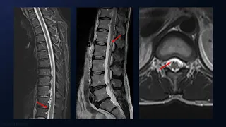 Microsurgical Resection of a Conus Medullaris Cavernous Malformation