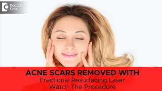 Get rid of ACNE SCARS with FRACTIONAL RESURFACING LASER - Dr. Deepak P Devakar | Doctors' Circle